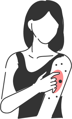 Person with arm swelling, redness, and tenderness